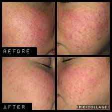 See full list on wikihow.com 28 Skincare Products That Ll Reduce Redness Real Fast