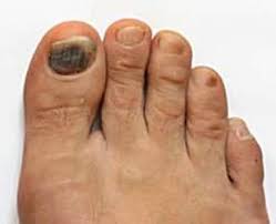 black spot under the toenail be fungus