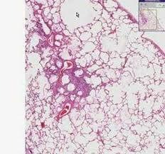 Allows tissue recoil following being stretched. Histopathology Lung Emphysema Youtube