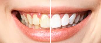 With philips zoom!, you get a safe whitening experience with little to no sensitivity. Preparing For Philips Zoom Whitening System Treatment Tooth Crusader