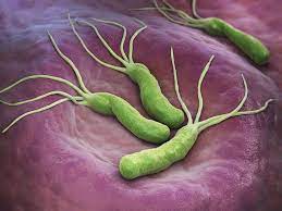 It was discovered in 1982 by two australian researchers who also found that it causes peptic ulcer disease. Mistakes In The Management Of Helicobacter Pylori Infection And How To Avoid Them Ueg United European Gastroenterology