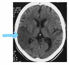 Image result for Chorea