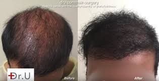 Im planning to do hair transplant too and did i a good amount of research! Bad Fue Hair Transplant Planning Head Donor Over Harvesting Poor Yield Dermhair Clinic