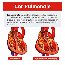 Image result for Cor Pulmonale