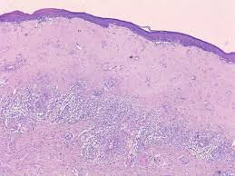 Lichen Sclerosus Im Kindesalter Springerlink