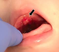 Image result for Uvulitis