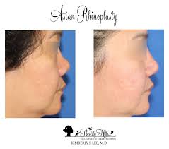 Rhinoplasty Gallery Rhinoplasty Facial Plastic Surgery Nose Job