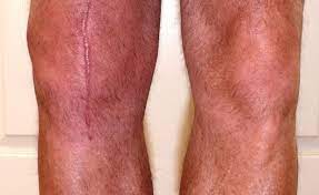 Possible Knee Replacement Surgery Complications Knee Replacement Knee Replacement Surgery Knee Replacement Exercises