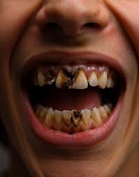 Dile adiós a los dientes amarillos, con esta mezcla tendrás dientes de un artista | Mi Amor Eres Tu | Facebook