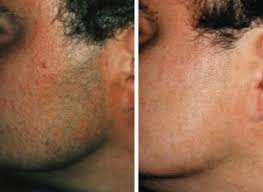 Many men choose laser hair removal as a way to get smooth skin without the itchy regrowth stage and painful bumps that typically form after regularly shaving over stubble. Laser Hair Removal Face Cost Off 59 Online Shopping Site For Fashion Lifestyle