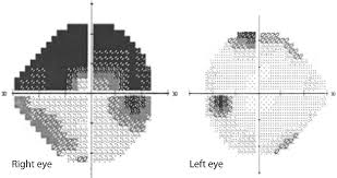 1 rapid diagnosis, immediate intervention, and referral can have profound effects on patient outcome and. Figure 1 From Refractory Acute Angle Closure Glaucoma With Retinal Ischemia January Consultation 1 Semantic Scholar
