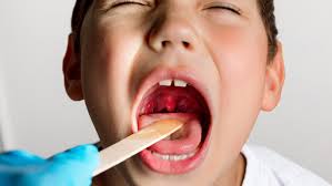 Image result for Tonsillitis