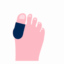 10 Step Guide For Treating Bunion Pain Neuhaus Foot Ankle Podiatry