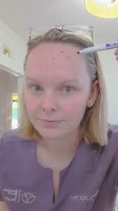 Frontalis Neurotoxin Placement , •••, 📞(762)303-0034, 👩‍💻  BoundlessBeautyATL.com, 📍326 Dahlonega St, Cumming, GA 30040, •••,  #Boundless #CummingMedSpa #Neurotoxins #Botox #Jeuveau #Dysport #Placement  ...