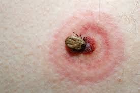 A cat's skin and fur is too thick for most spider species' fangs to penetrate. Diagnosing And Treating Insect Bites And Stings On The Lower Extremity Podiatry Today