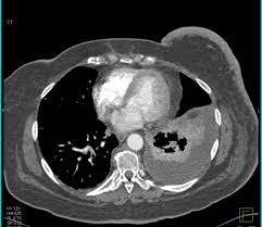 Drugs may be injected directly into the arteries. Inflammatory Breast Cancer With Pleural Metastases Chest Case Studies Ctisus Ct Scanning