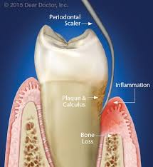 The device comes equipped with a 5 mega pixel. Save A Tooth Or Get An Implant