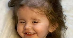 Girl with condition that makes her pull hair out is to get head shaved to  raise funds for child with cancer