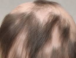 Hair loss is common after a major surgical procedure, pregnancy or when you're under a lot of stress. Psychological Effects Of Hair Loss Dermnet Nz