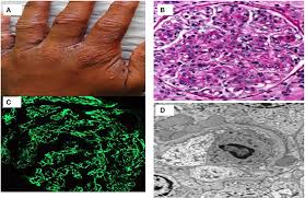 This technique can be utilized to visualize the. Frontiers Infection Induced Kidney Diseases Medicine