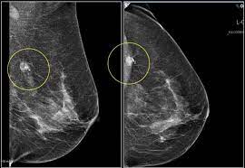 The radiologist will check their shape and pattern, as they mammograms are still possible if a person has had breast cancer surgery or implants. False Mammograms Are More Common Than You Think Dennis R Holmes M D F A C S Breast Cancer Surgeon