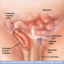 Inguinal Hernia Medical Bariatric Surgeon Hernia Inguinal