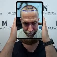 London Hair Transplants