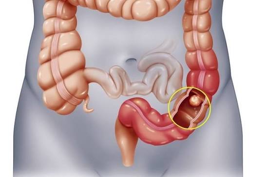 Điều trị ung thư đại tràng như thế nào để tránh tái phát | BvNTP