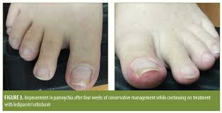 Image result for Paronychia feet