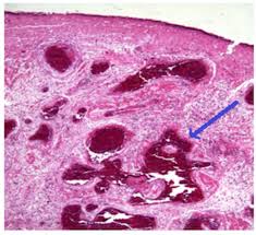 A nasal polyp is a benign (noncancerous) tumor that grows from the lining of the nose or sinuses. Cureus Clinical And Pathological Features Of Angiomatous Nasal Polyps A Report Of Four Cases And Review Of Literature