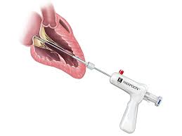 Then, at level 50, you will begin to catch an array of tuna and swordfish. Edwards Lifesciences Launches Pivotal Trial Of Mitral Valve Repair System 2020 12 22 Bioworld