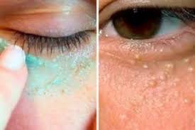 как избавиться от белых пятен на лице в домашних условиях Kak Legko Izbavitsya Ot Milii V Domashnih Usloviyah Lico Sekrety Krasoty Pod Glazami