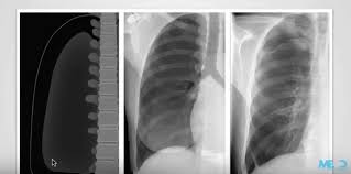 Image result for Pneumothorax