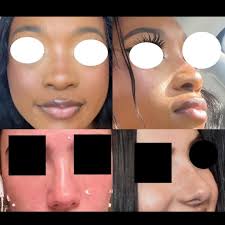 realistic african american rhinoplasty wish pic?? : r/cosmeticsurgery