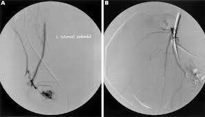 Maybe you would like to learn more about one of these? Traumatic Priapism An Unusual Cycling Injury British Journal Of Sports Medicine
