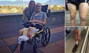 Usually, osteosarcoma develops in the long bones of the front legs, though the rear legs, jaw, face bones, ribs, and vertebrae can all be affected, as well. Teenager Who Lost His Leg To A Bone Cancer Has A New Knee Formed From His Backwards Foot Daily Mail Online