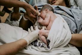 Image result for Forceps Assisted Delivery