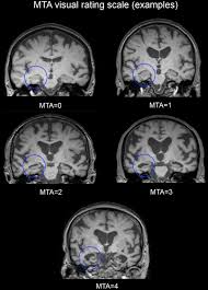 Lewy body dementia stage 2 possibilities. Multimodal Eeg Mri In The Differential Diagnosis Of Alzheimer S Disease And Dementia With Lewy Bodies Sciencedirect
