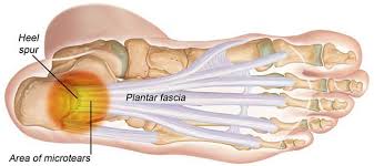 Pin On Plantar