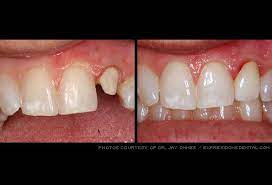 Pin On Cosmetic Dentistry