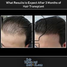 Pin On Hair Loss Treatments