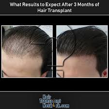 Whatever surgery you choose, the transplanted hair will usually fall out within 2 to 3 weeks after your surgery, so you'll be. Pin On Hair Loss Treatments