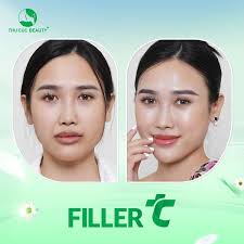 Tiêm filler bị vón cục có phải biến chứng không?