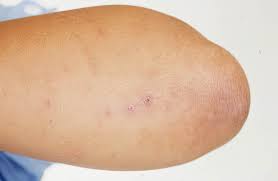 Image result for gonorrhea symptoms