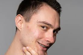 Iritasi Kulit Wajah: Penyebab, Gejala, dan Cara Mengatasi