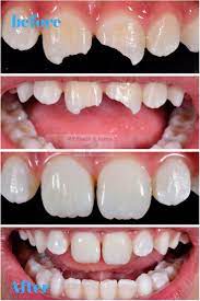 Before And After Image Of Broken Tooth Repaired With Cosmetic Dentistry Tooth Repair Broken Tooth Repair Cosmetic Dentistry