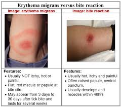 Image result for infected tick bite