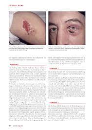 Das therapeutische konzept umfasste radikale etappendébridements mit mikrobiologischen probeentnahmen, vakuumverbänden und die testgerechte lokale und systemische antibiotikatherapie. Mrsa Kolonisation Rosenfluh Ch