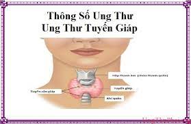 Bệnh không có dấu hiệu rõ ràng, âm thầm di căn đến nhiều bộ phận khác. Thong Sá»' Ung ThÆ° Ung ThÆ° Tuyáº¿n Giap Ung ThÆ° Phá»•i