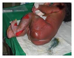 Staphylococcal scalded skin syndrome, arch. Staphylococcal Scalded Skin Syndrome In A Newborn With Generalized Download Scientific Diagram